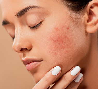 Inflamação de Acne