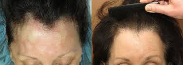 Women hair transplant Islamabad