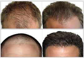 hair transplant Islamabad