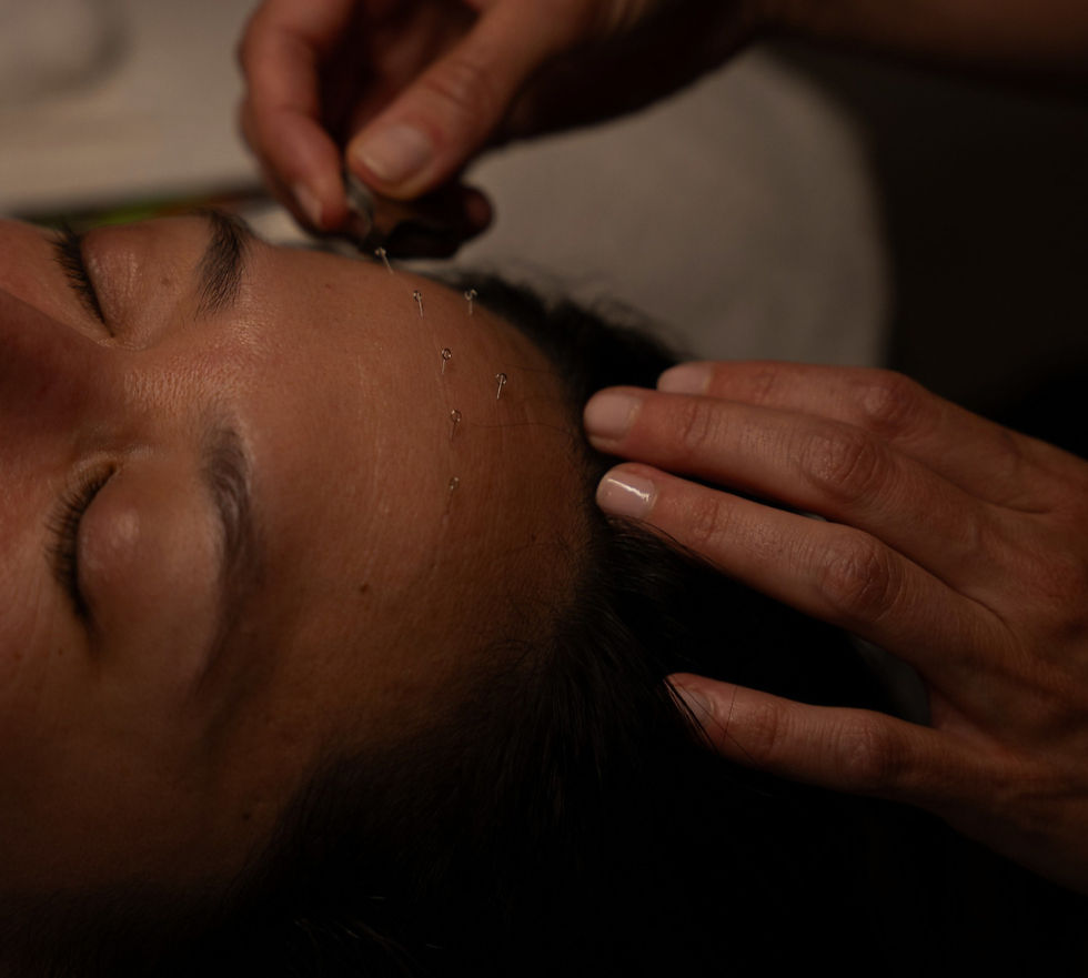 cosmetic acupuncture wrinkle threading los angeles