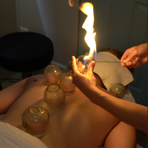 Fire Cupping: History, Benefits, and Who It’s For