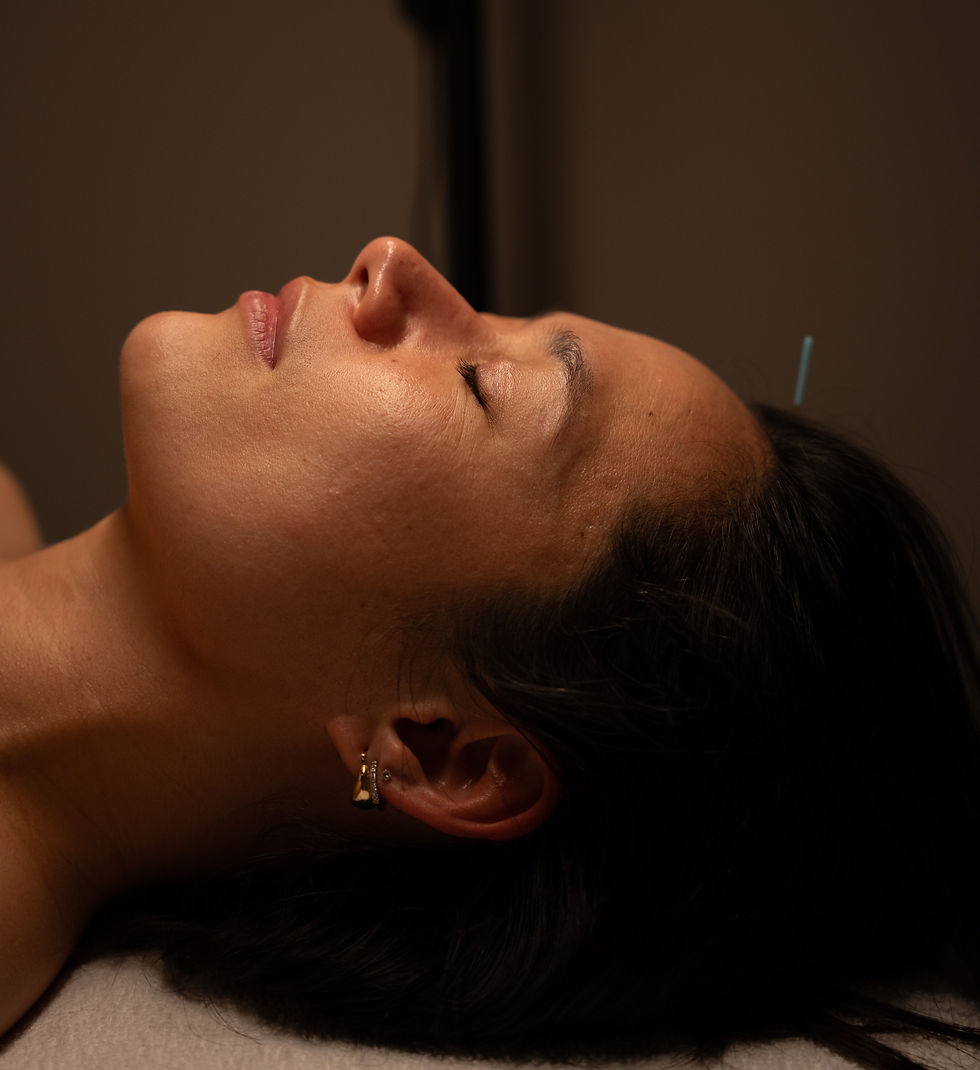 cosmetic acupuncture santa monica woman laying with needles