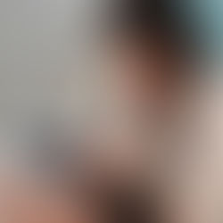 Microneedling for Pore Size in Santa Monica