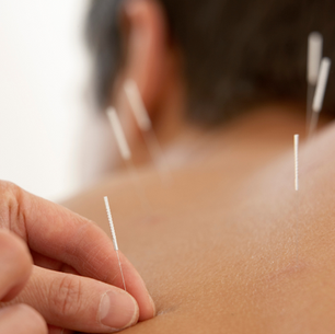 Acupuncture for Back Pain in Santa Monica | Natural Relief for Muscle Tension & Injury