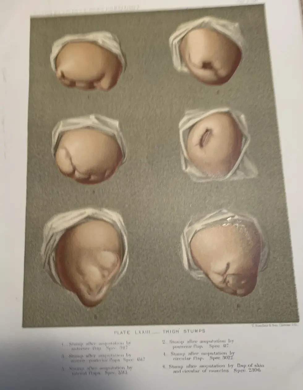 Thumbnail: Six (6) Period Medical Prints of Wounds and Amputations Some Identified