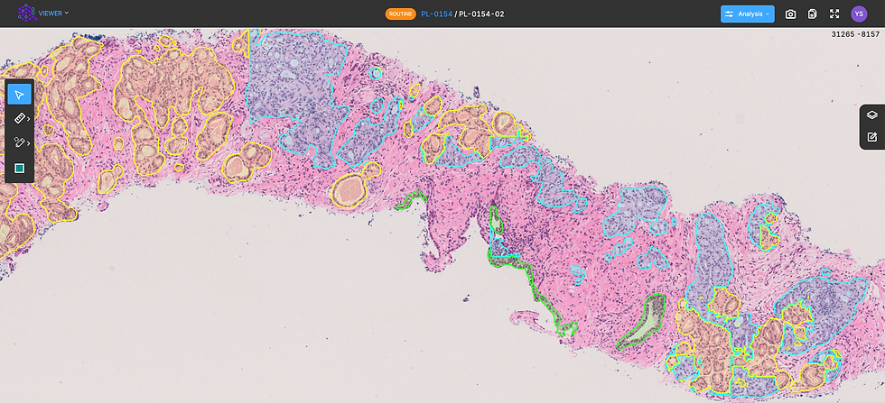 With QAi Prostate Grade Overlay