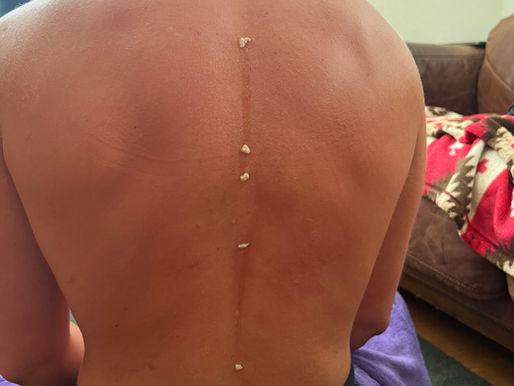 Kambo and Chinese Medicine: Tribal meets Eastern 