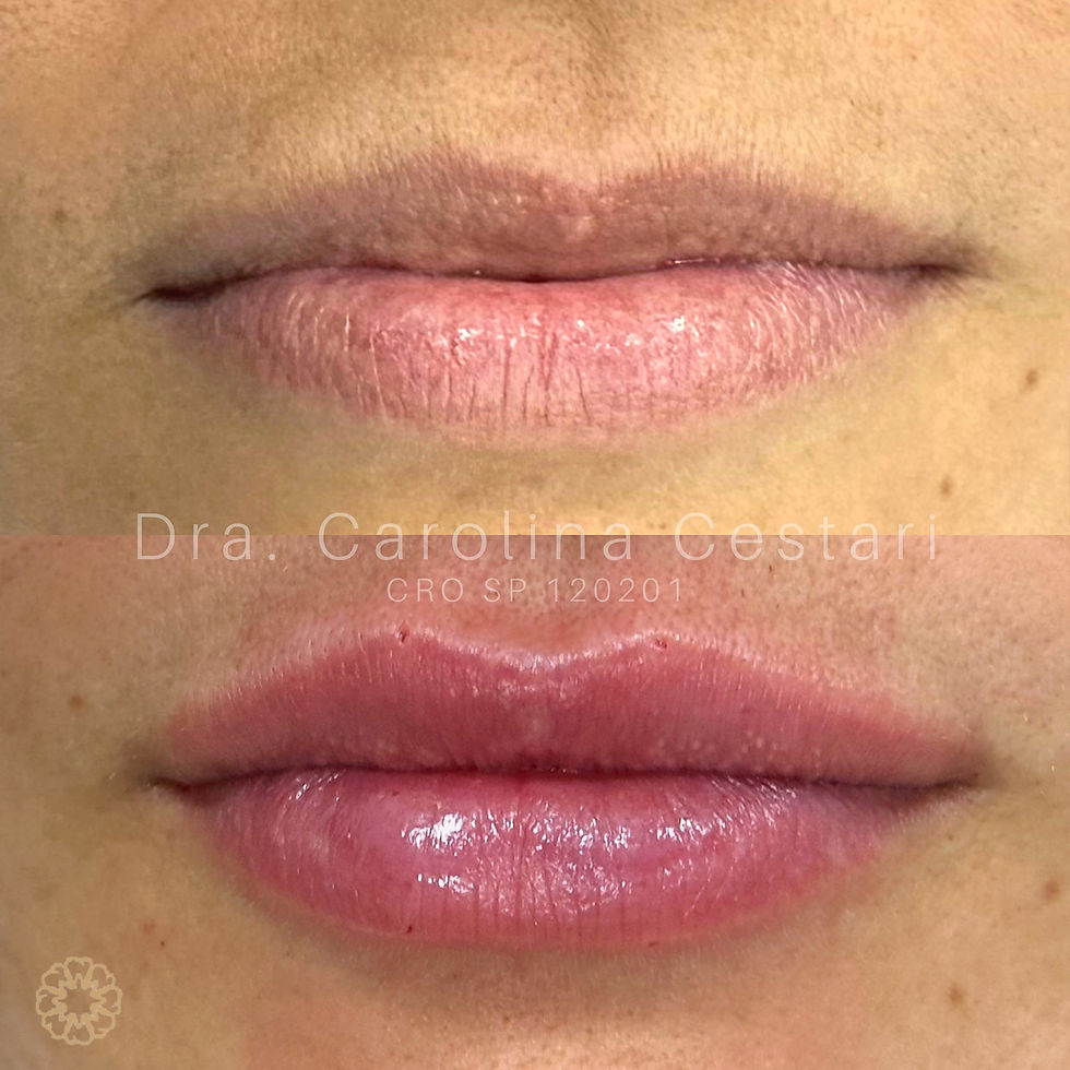 Preenchimento labial