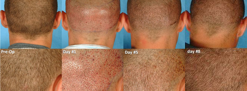 La Jolla Med Spa - Donor site healing stages