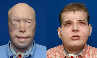 Firefighter receives full face transplant in 'historic' surgery