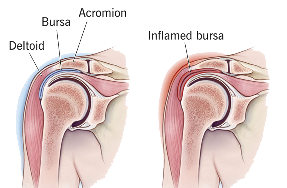 Shoulder Impingement