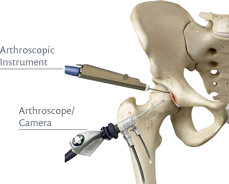 Hip Arthroscopy