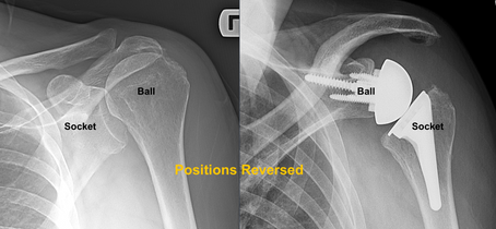 Reverse Shoulder Replacement