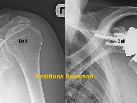 Reverse Shoulder Replacement