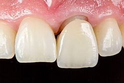 protesis dental collado villalba