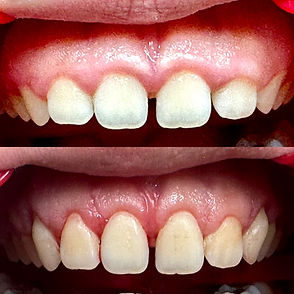 Before and After Gingival Correction of a Gummy Smile