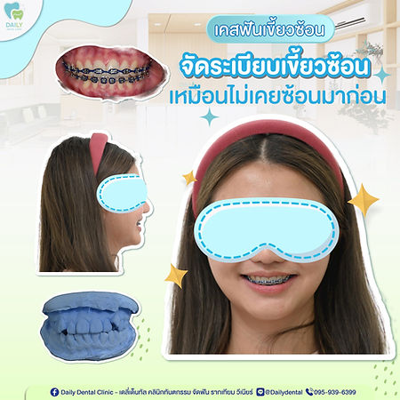 review-brace-from-dailydental-clinic