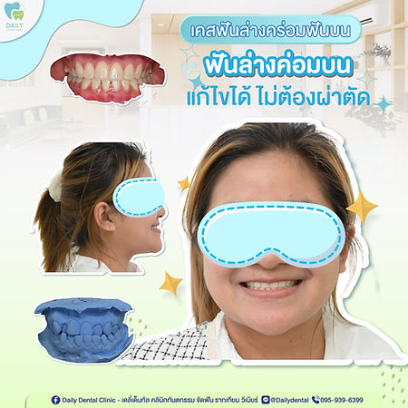 review-brace-from-dailydental-clinic
