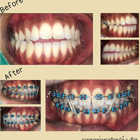 review-brace-from-dailydental-clinic