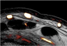 MRI Skin Vessels