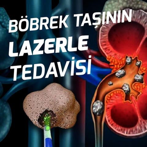 BÖBREK TAŞ HASTALIKLARI
