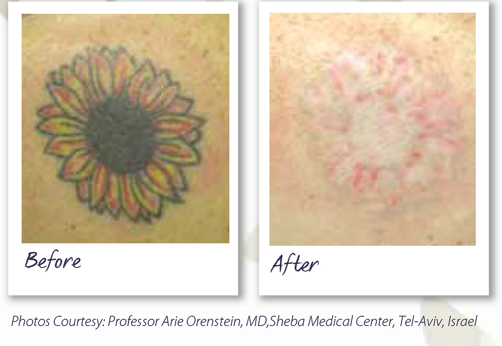 billings laser tattoo removal