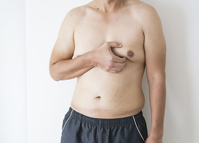 gynecomastia-4.jpg