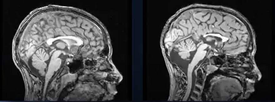 Brain cerebelum FASD.png