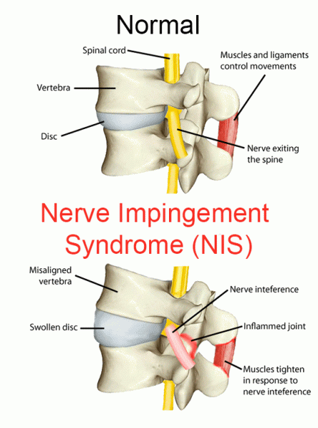  NERVE ROOT IMPINGEMENT