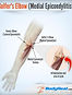 golfers-elbow-tennis-elbow-medial-epicon