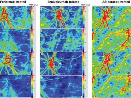 「抗VEGF薬で眼血流はどう変わる?―投与30分後の比較で見えた違い」新着論文紹介