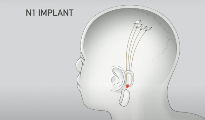 O implante cerebral da Neuralink