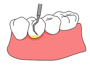 歯周病