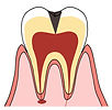 虫歯
