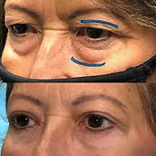 DERMATOCALASE.jpeg
