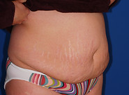 Case 16 Tummy Tuck Before Photo 2