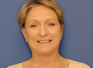 Case 16 Face Lift After Photo 1