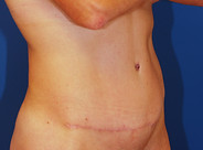 Case 19 Tummy Tuck After Photo 2