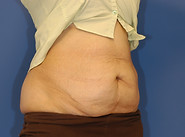 Case 14 Tummy Tuck Before Photo 2