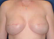 Case 16 Breast Reconstruction After Photo 1