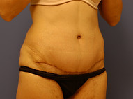 Case 14 Tummy Tuck After Photo