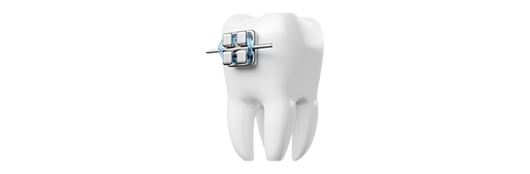 3D-модель зубного ряду з установленими брекетами