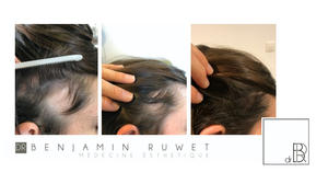 Mesothérapie du cuir chevelu HAIRCAIRE