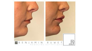 Profiloplastie - correction d'un menton fuyant