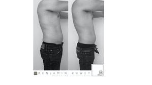Cryolipolyse