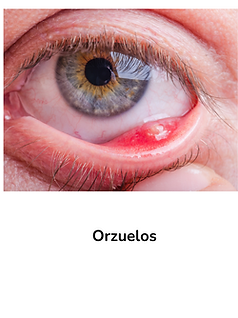 Orzuelos.png