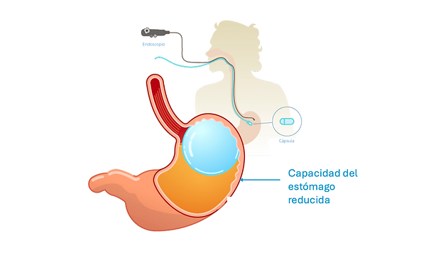 Balón Gástrico por Endoscopía