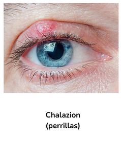 Chalazion.png
