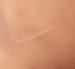 Image of a linear surgical scar
