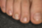 Foot with nail with nail disease or nail fungus